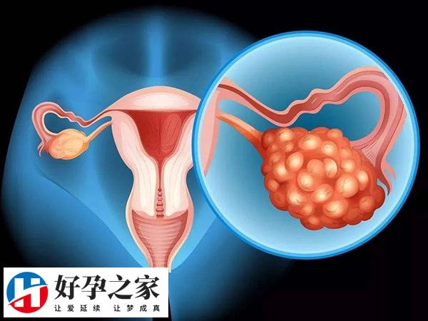 抗缪勒氏管激素偏高是不是多囊